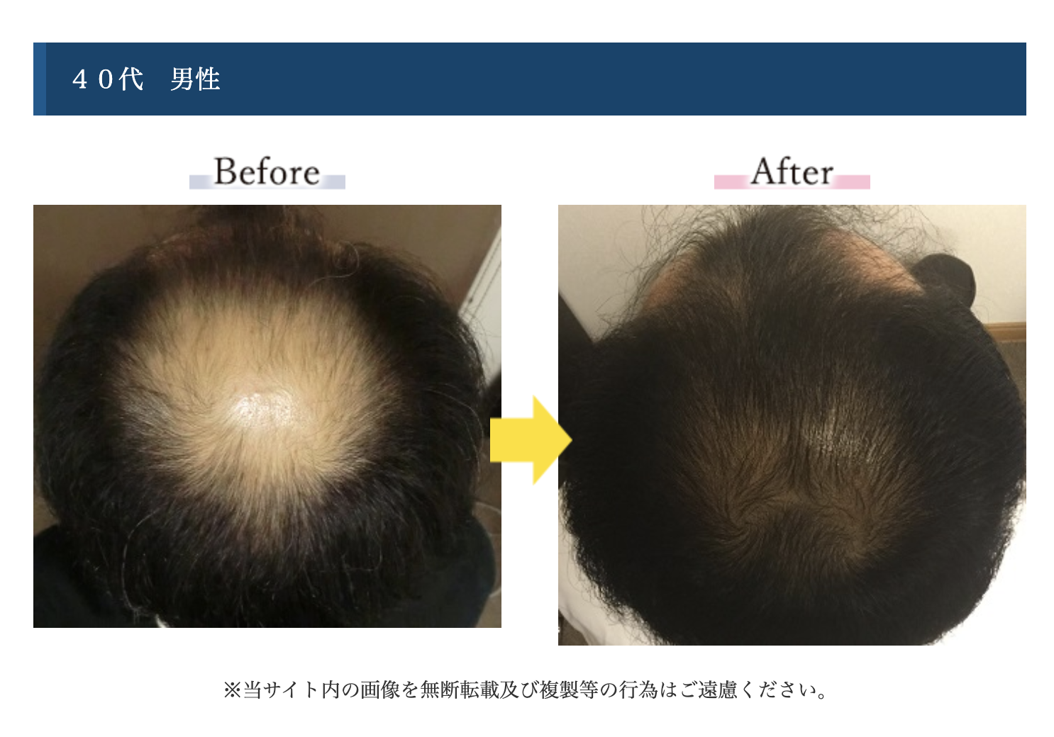 福岡 抜け毛 予防】皮脂・臭いは危険信号！博多祇園駅前店の「再発しない体質改善」 - スーパースカルプ発毛センター博多祇園駅前店