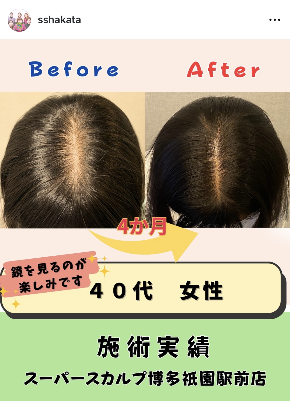 症例40代女性産後抜け毛